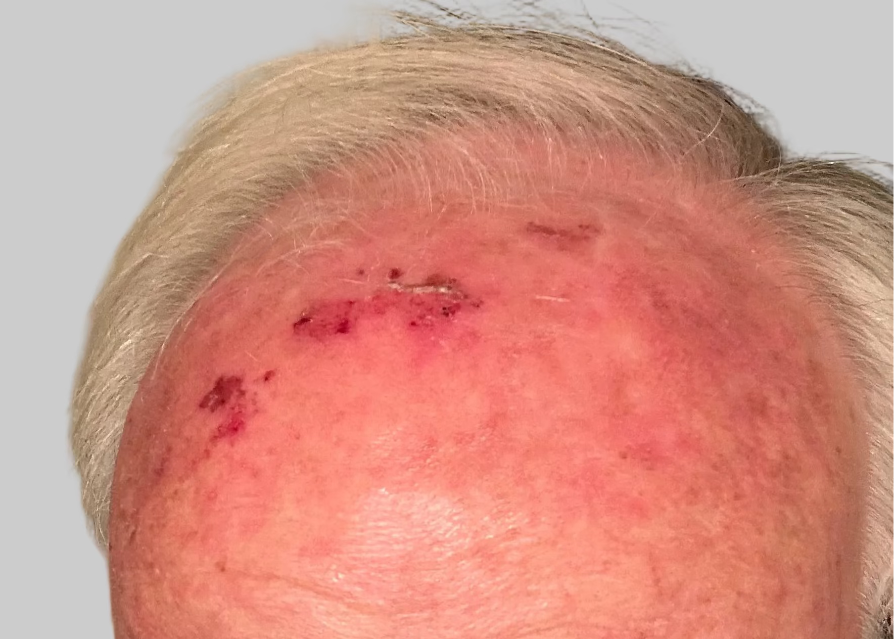 Man with a visible head injury looking at the camera.