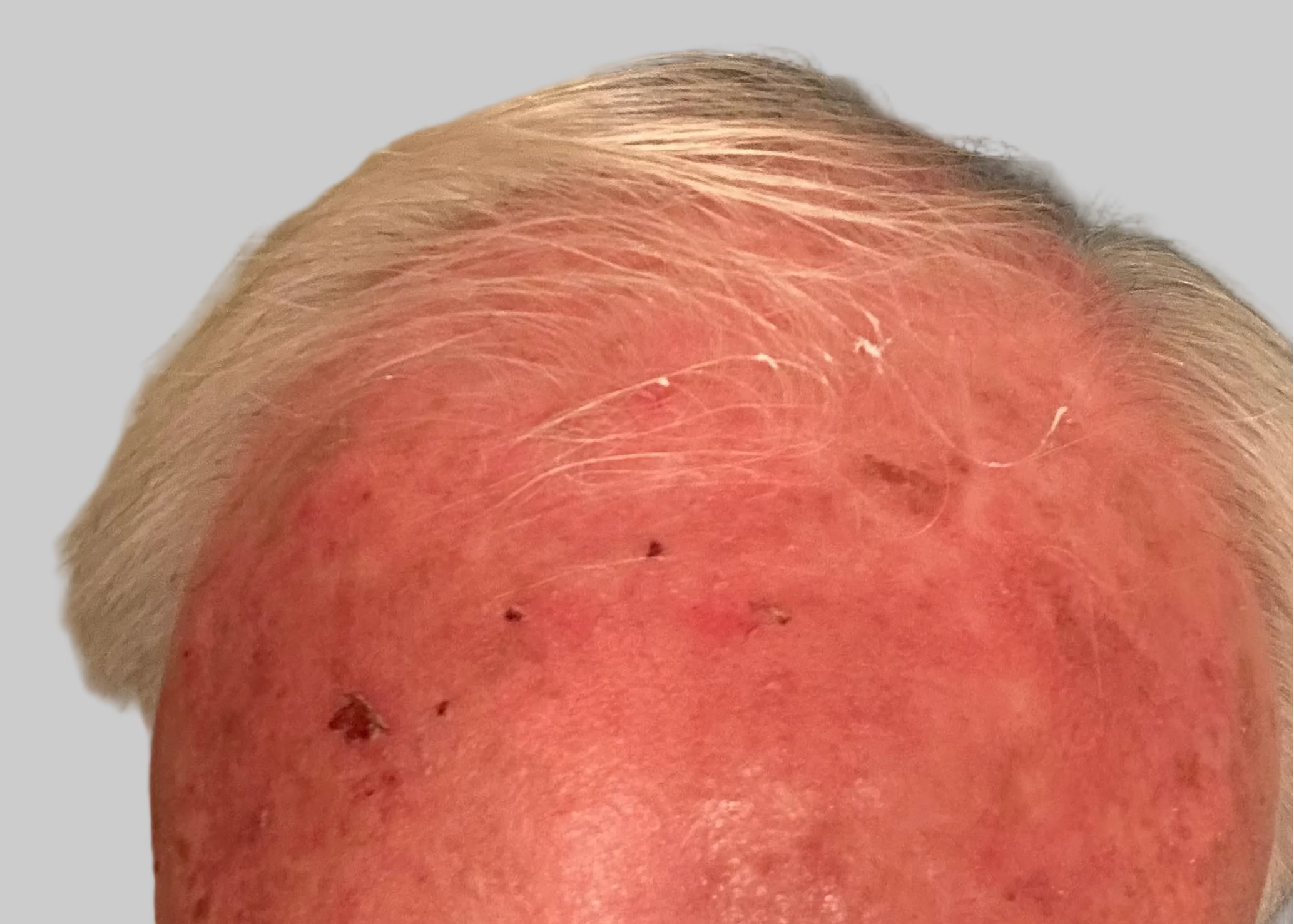 Close-up of a person's head healed on a plain background
